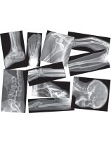 Broken Bones X-Rays - Set of 15