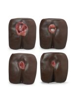 Life/form® Pressure Ulcer/Bedsore Model - Dark