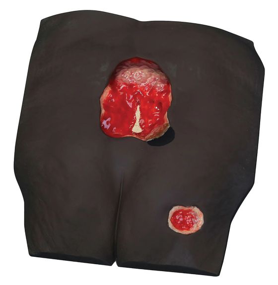 Stan's Stage 4 Pressure Ulcer Model - Dark