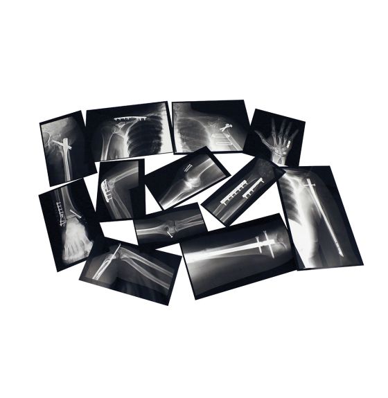 Rayons X d’os réparés Roylco®