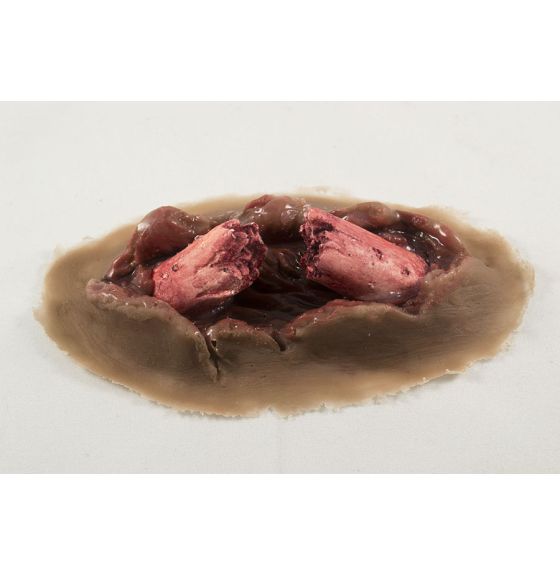 MST&trade; Dynamic (Bleeding) Compound Fracture Moulage - Dark Colour - Single