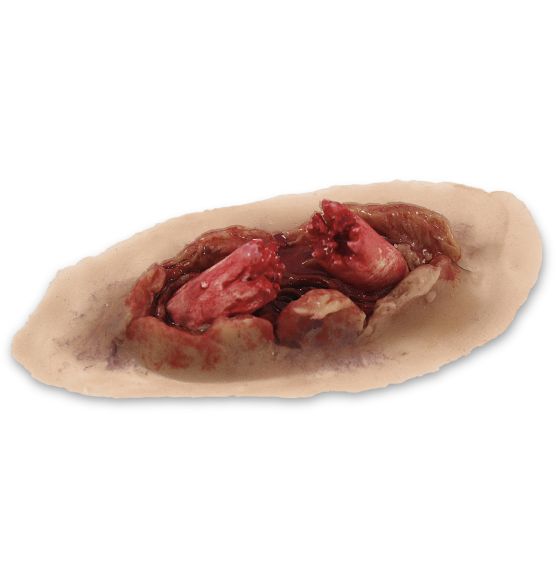MST&trade; Dynamic (Bleeding) Compound Fracture Moulage - Manikin Colour - Single